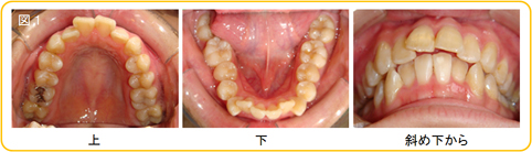 矯正治療の抜歯について