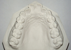 矯正治療の抜歯について３