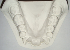 矯正治療の抜歯について３