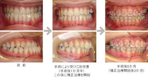 噛み合わせの状態や歯のでこぼこ具合によっては、先に術前矯正を行い治療を進めた方がよい場合もあります