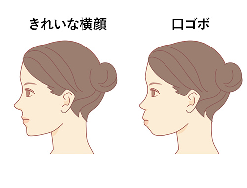 口ゴボとは？